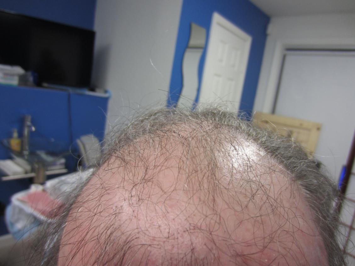 Before Hair Restoration in Houston