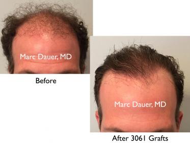 Click image for larger version

Name:	Hair Transplant Slides copy15.001.jpg

Size:	13.6 KB
ID:	45703