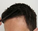Hairline view after 1156 follicular units