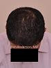 Click image for larger version

Name:	Anderson Center for Hair Restoration Transplant (5).jpg

Size:	42.1 KB
ID:	45736