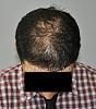 Click image for larger version

Name:	Anderson Center for Hair Restoration Transplant (3).jpg

Size:	64.8 KB
ID:	45738