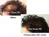 Click image for larger version

Name:	Hair Transplant Slides7.358.jpg

Size:	71.6 KB
ID:	36209