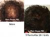 Click image for larger version

Name:	Hair Transplant Slides7.360.jpg

Size:	83.3 KB
ID:	36211