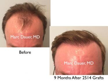 Click image for larger version

Name:	Hair Transplant Slides copy20.001.jpg

Size:	13.2 KB
ID:	44548