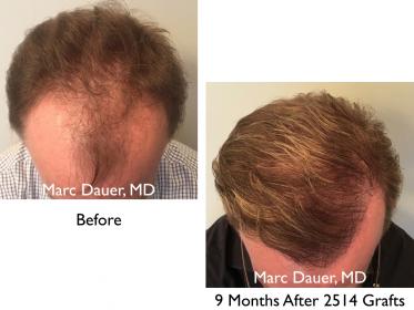 Click image for larger version

Name:	Hair Transplant Slides copy20.004.jpg

Size:	15.7 KB
ID:	44551