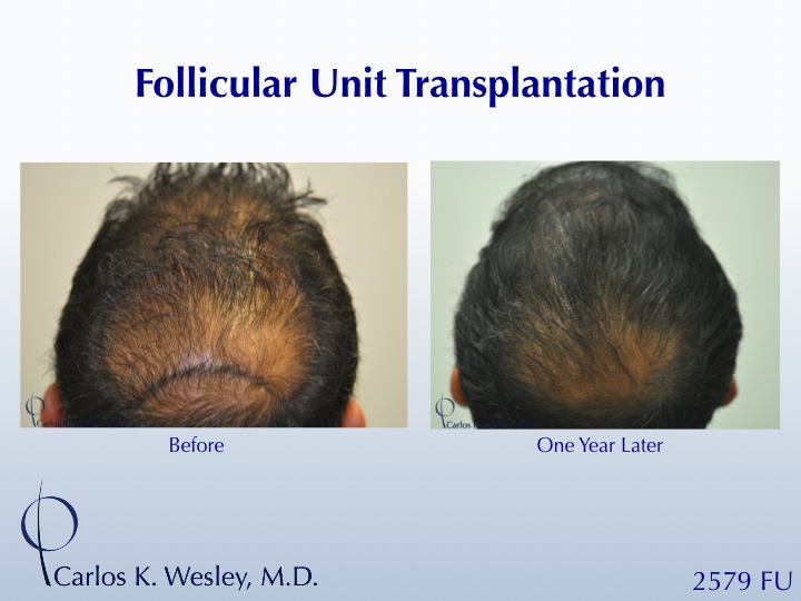 A 34-year-old male had 2579 FU added to his mid scalp to minimize his balding crown.