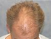 Click image for larger version

Name:	06_before-hair-transplant-top-view.jpg

Size:	59.9 KB
ID:	7533