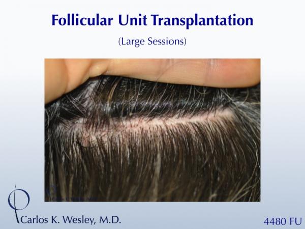Donor scar after a total of 4480 grafts were transplanted to the frontal half of his scalp in order to create a natural-appearing hairline with...