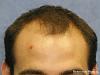 Click image for larger version

Name:	03_before-hair-transplant.jpg

Size:	23.3 KB
ID:	24960