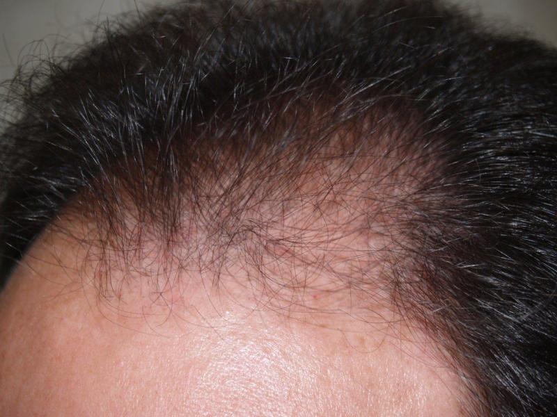 Before FUE procedure