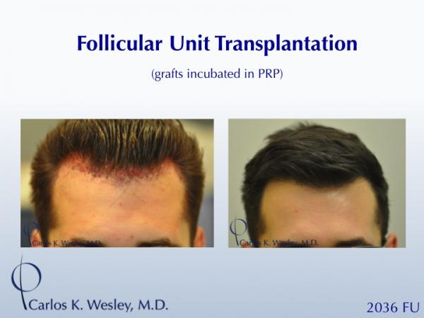 25-year-old male with 2034 FU session with Dr. Carlos K. Wesley for hairline fullness.