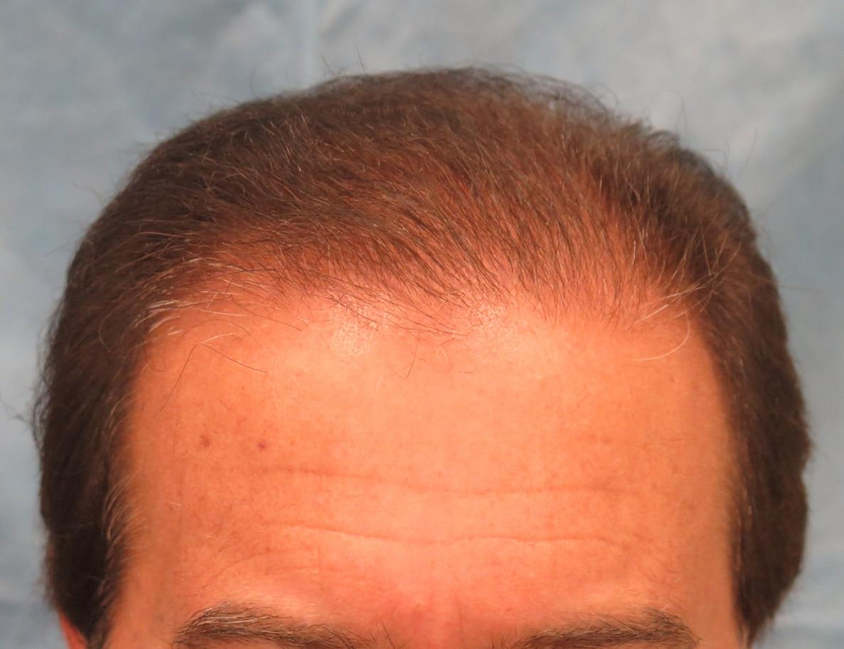 1 Year After Hair Transplant