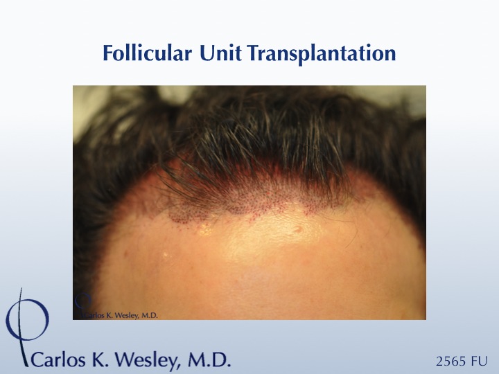 This 32-year-old male is seen during a 2565 graft session with Dr. Wesley in NYC. 
 
Interactive before/after images of this patient may be seen...