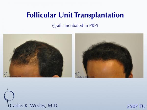 22-year-old male before and after 2507 grafts to the frontal third of his scalp by Dr. Carlos K. Wesley.  
 
A video montage of his transformation...