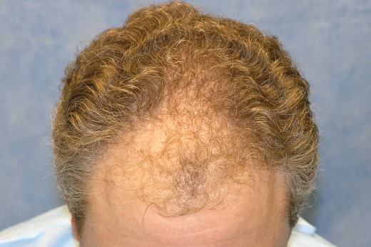 Click image for larger version

Name:	05_before-hair-transplant-top-view.jpg

Size:	58.4 KB
ID:	7412