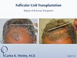 This patient presented to Dr. Carlos K. Wesley (NYC) after having undergone a hair transplant session at a different NYC surgical office.  His...