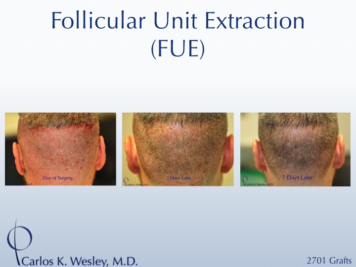 More examples of Dr. Wesley's patients' FUE donor recovery processes can be viewed in this video montage: 
 
https://vimeo.com/70354892