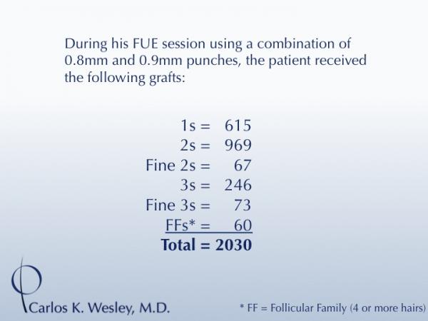 Before and 13 months after FUE with Carlos K. Wesley (NYC).