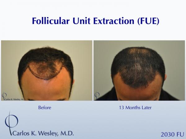 Before and 13 months after FUE with Carlos K. Wesley (NYC).