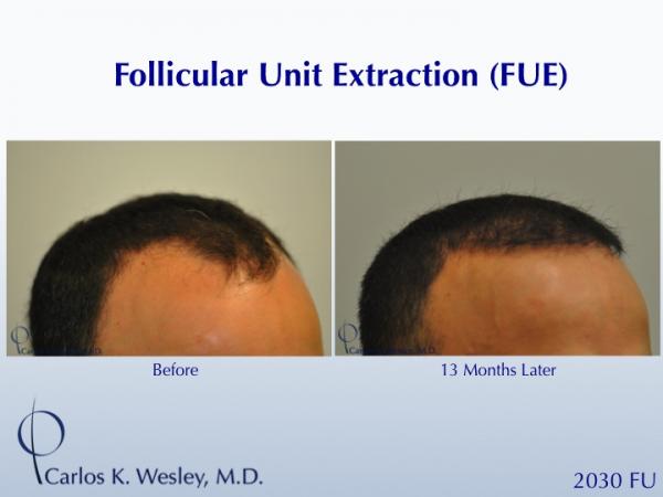 Before and 13 months after FUE with Carlos K. Wesley (NYC).