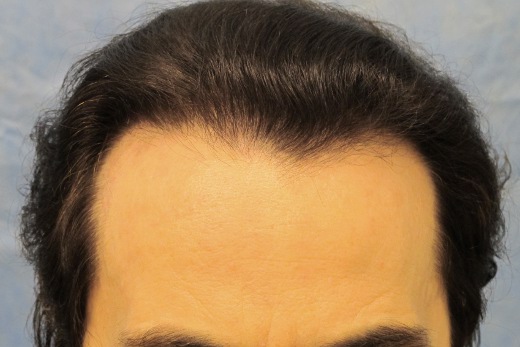 Click image for larger version

Name:	06_after-2nd-hair-transplant.jpg

Size:	58.2 KB
ID:	13007