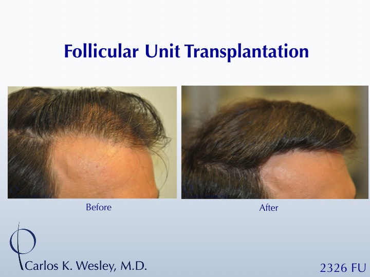 This 42-year-old man simply wanted a thicker hairline.  A 2326 FU session with Dr. Carlos K. Wesley (NYC) helped him accomplish his objective.