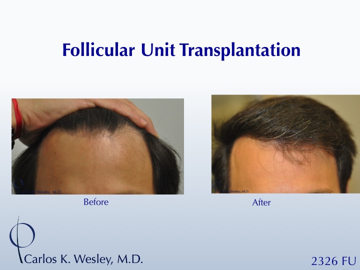 This 42-year-old man simply wanted a thicker hairline.  A 2326 FU session with Dr. Carlos K. Wesley (NYC) helped him accomplish his objective.