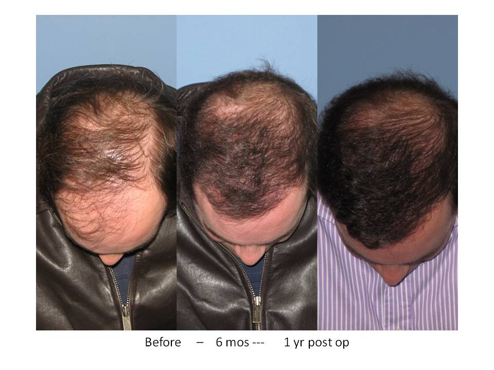 Dr. Paul Shapiro, MD 
FUT 
4000 grafts/8274 hairs 
12 months post-op