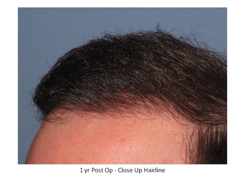 Dr. Paul Shapiro, MD 
FUT 
4000 grafts/8274 hairs 
12 months post-op