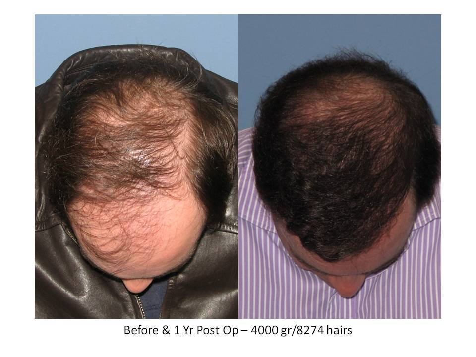 Dr. Paul Shapiro, MD 
FUT 
4000 grafts/8274 hairs 
12 months post-op