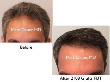 Click image for larger version

Name:	Hair Transplant Slides copy36.001.jpg

Size:	13.3 KB
ID:	45221