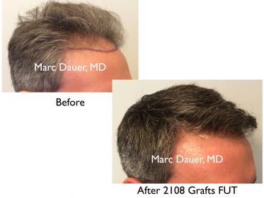 Click image for larger version

Name:	Hair Transplant Slides copy36.004.jpg

Size:	14.2 KB
ID:	45224