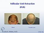 Early growth after this young man's 1701 graft FUE session with Dr. Carlos K. Wesley (NYC).  At only 7 months postoperatively, his recipient growth...