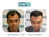 5025 hair implanted,9 months result