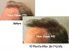 Click image for larger version

Name:	Hair Transplant Slides2.319.jpg

Size:	72.0 KB
ID:	35730
