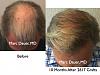 Click image for larger version

Name:	Hair Transplant Slides2.318.jpg

Size:	91.3 KB
ID:	35732