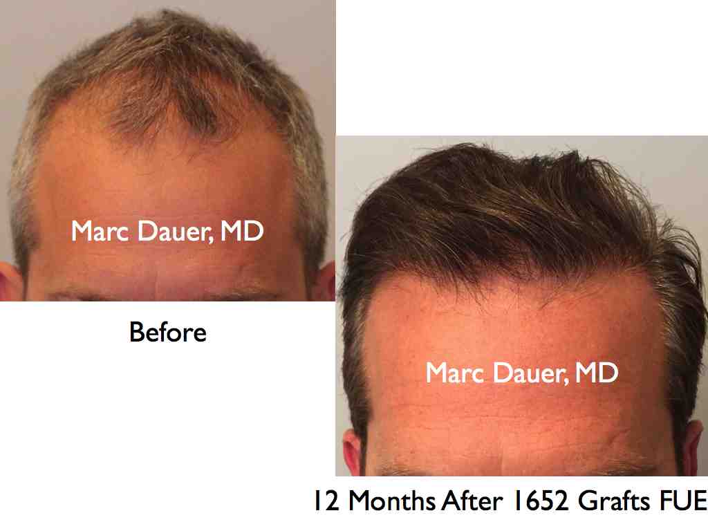 Click image for larger version

Name:	Hair Transplant Slides.539.jpg

Size:	37.1 KB
ID:	38559