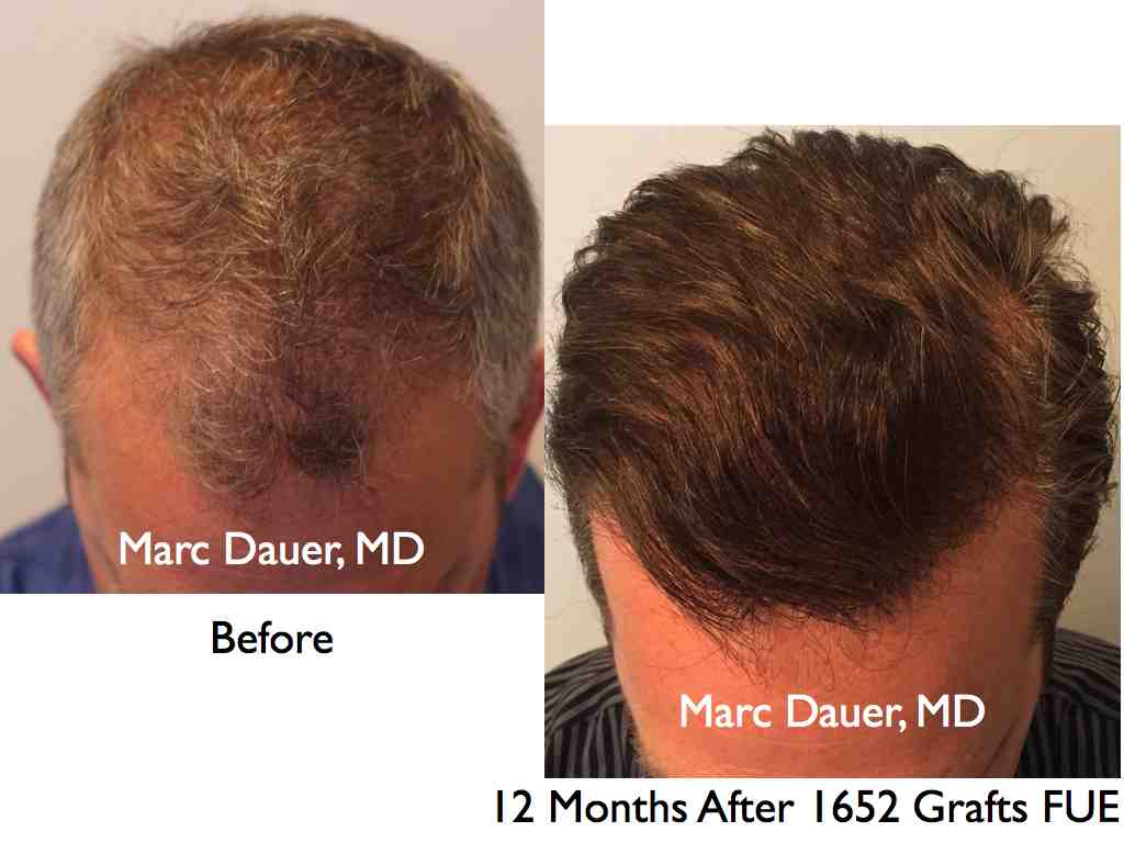 Click image for larger version

Name:	Hair Transplant Slides.542.jpg

Size:	45.5 KB
ID:	38562