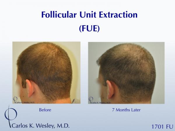 Early growth after this young man's 1701 graft FUE session with Dr. Carlos K. Wesley (NYC).  At only 7 months postoperatively, his recipient growth...