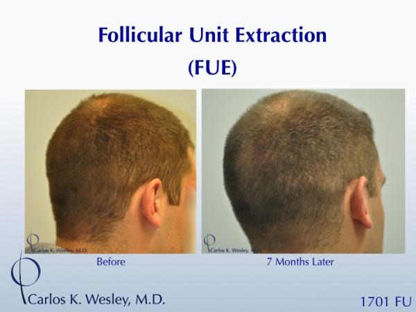 Early growth after this young man's 1701 graft FUE session with Dr. Carlos K. Wesley (NYC).  At only 7 months postoperatively, his recipient growth...