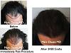 Click image for larger version

Name:	Hair Transplant Slides1.242.jpg

Size:	84.1 KB
ID:	34139