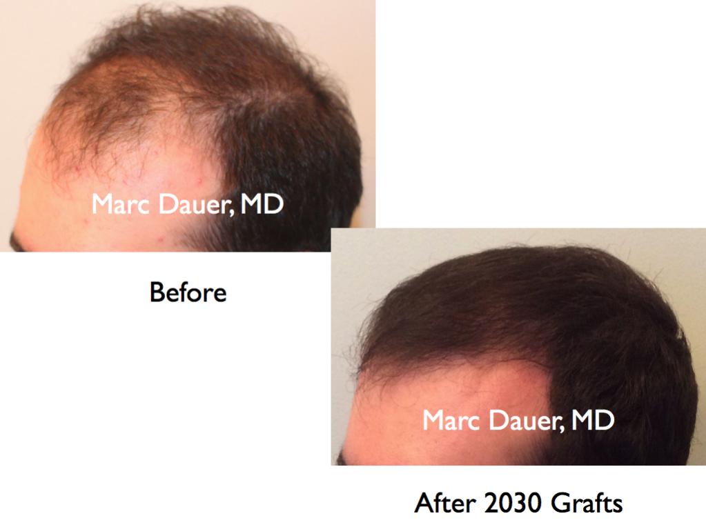 Click image for larger version

Name:	Hair Transplant Slides7.253.jpg

Size:	50.9 KB
ID:	34439