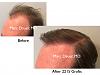 Click image for larger version

Name:	Hair Transplant Slides3.002.jpg

Size:	11.7 KB
ID:	42440