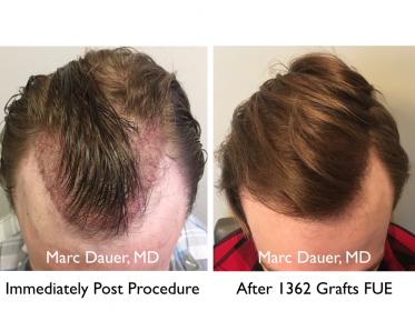 Click image for larger version

Name:	Hair Transplant Slides copy11.001.jpg

Size:	18.6 KB
ID:	45516