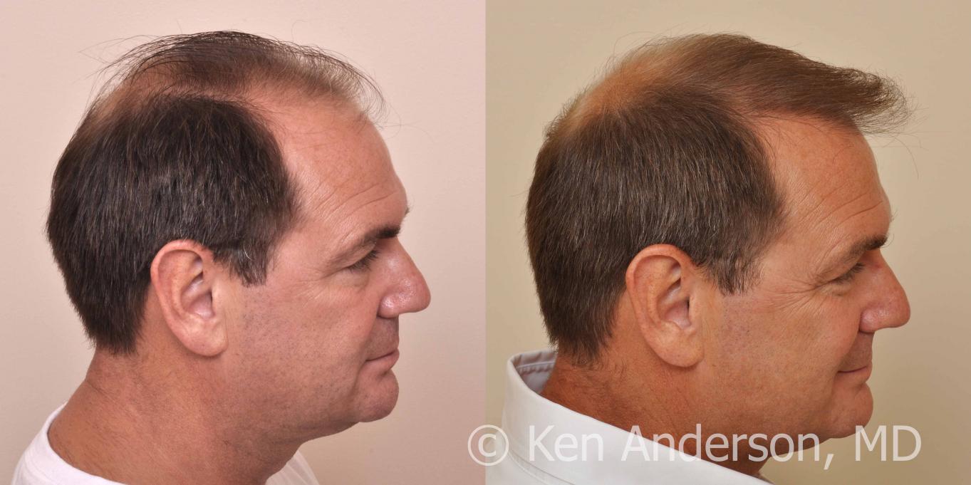 57 year old man who had an ARTAS Robotic Hair Transplant by Dr. Ken Anderson, at the Anderson Center for Hair in Atlanta, Georgia.