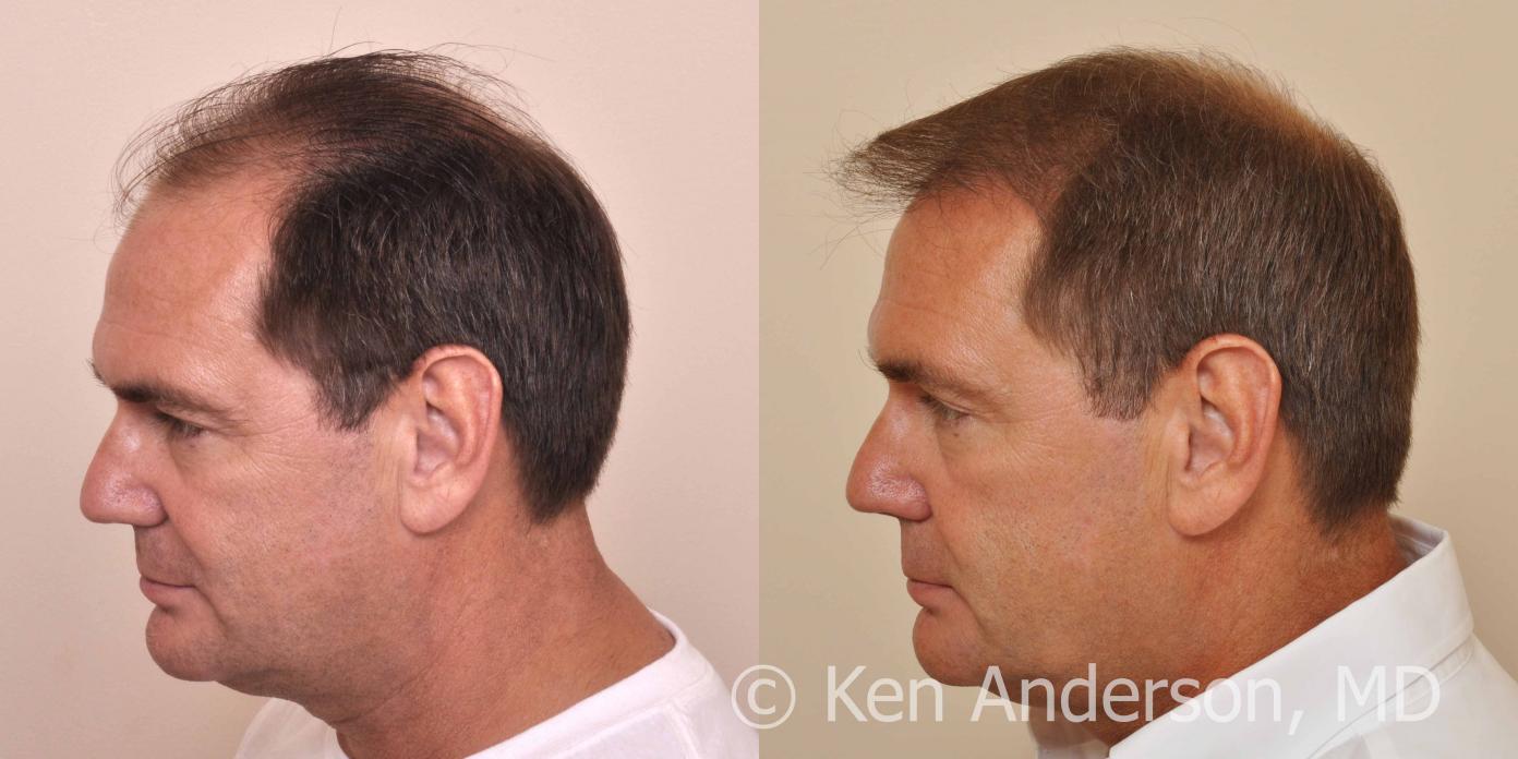 57 year old man who had an ARTAS Robotic Hair Transplant by Dr. Ken Anderson, at the Anderson Center for Hair in Atlanta, Georgia.