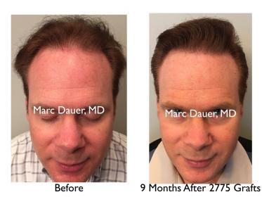 Click image for larger version

Name:	Hair Transplant Slides copy50.007.jpg

Size:	16.1 KB
ID:	46809