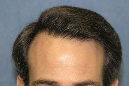 After 1st Hair Transplant Session 
 
View his full photoset >> http://www.bernsteinmedical.com/hair-transplant-photos/portraits/patient-rpc/