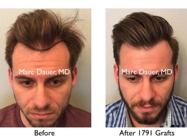 Click image for larger version

Name:	Hair Transplant Slides copy12.001.jpg

Size:	17.6 KB
ID:	45555