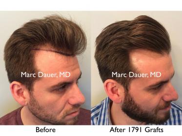 Click image for larger version

Name:	Hair Transplant Slides copy12.003.jpg

Size:	17.6 KB
ID:	45557